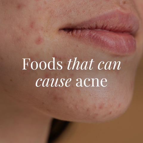 Foods that can causes acne!