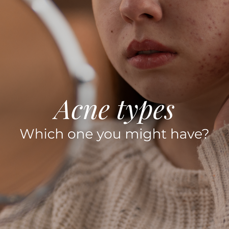 Acne types and which one you might have